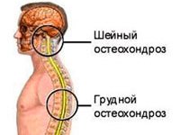 Фитнес и гимнастика при остеохондрозе